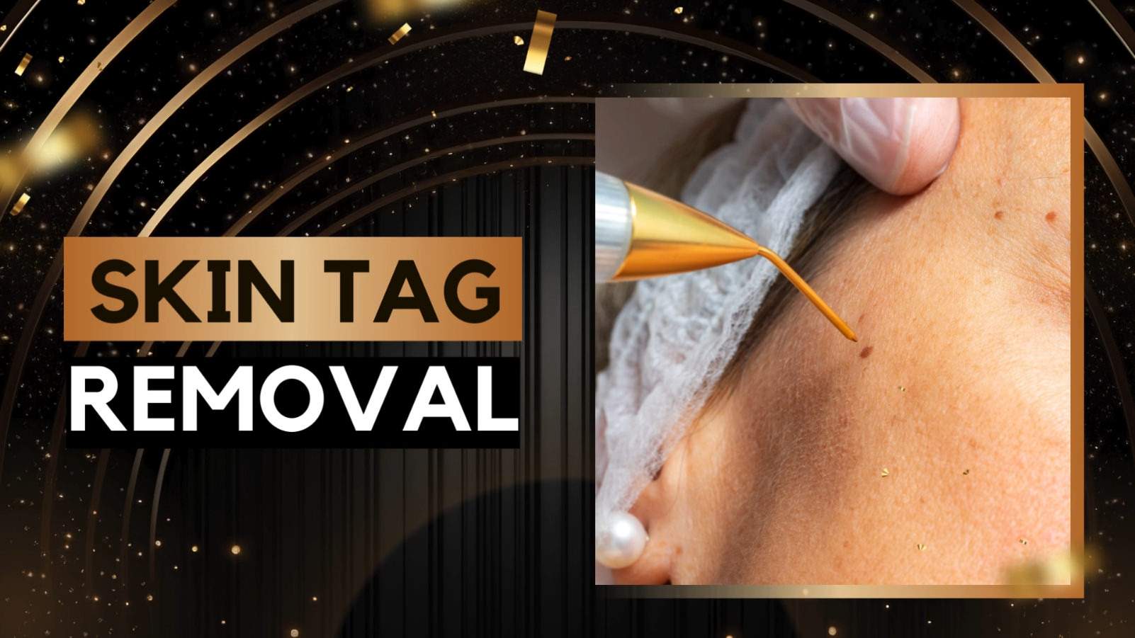 Skin Tag Removal 01-Nails-N-CV