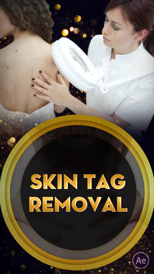Skin Tag Removal 02-Nails-D-AE