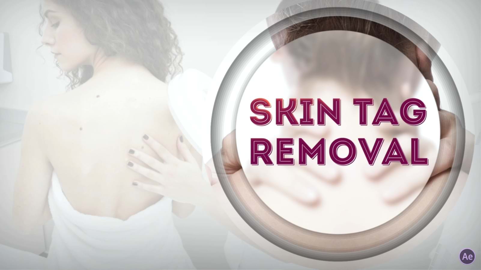 Skin Tag removal 01-Nails-N-AE