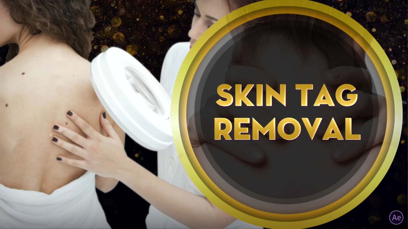 Skin Tag removal 02-Nails-N-AE