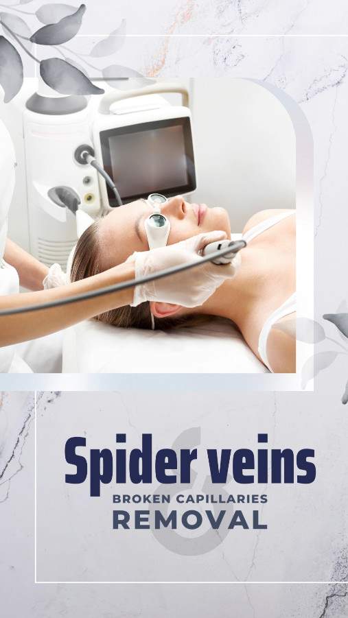 Spider veins & broken capillaries removal 01-Nails-D-CV